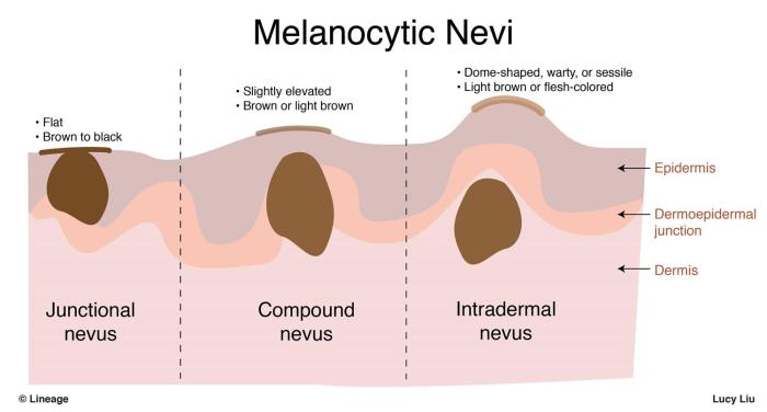 Compound dysplastic nevus with mild atypia positive margins