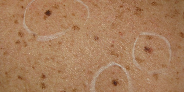 Compound dysplastic nevus with mild atypia positive margins