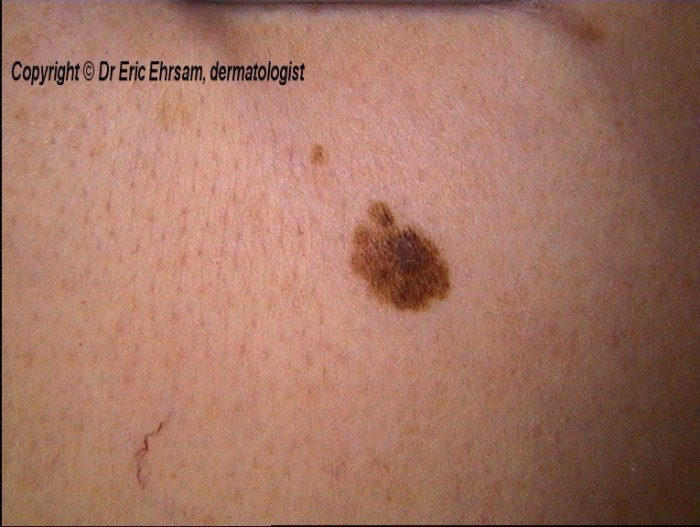 Nevus dysplastic melanocytic nevi atypical atypia disorder cytologic architectural including figure